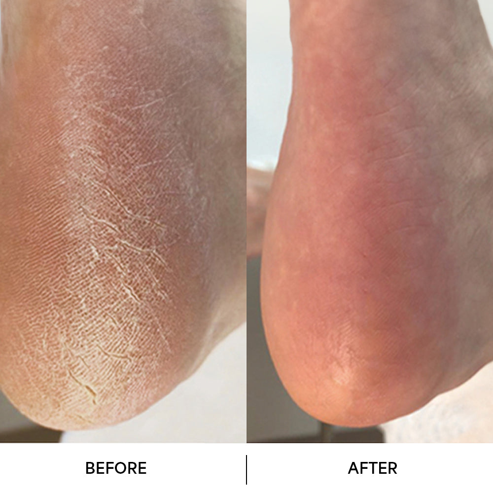 Dermave Electric Foot Callus Remover